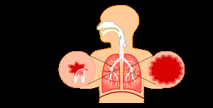Asthma