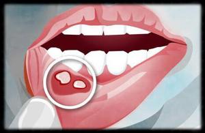 口腔溃疡，你应该了解的知识-京东健康-京东健康