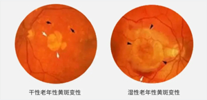 关注老年疾病：年龄相关性黄斑变性（AMD） - 企业动态- 丁香通