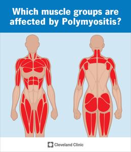 Polymyositis: What It Is, Causes, Symptoms & Treatment