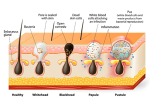 acne vulgaris: Origins, symptoms and current treatments