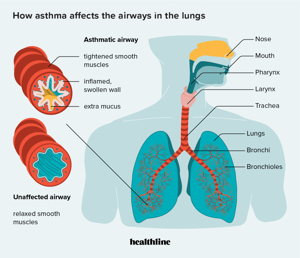 How Can Asthma Affect the Respiratory System?