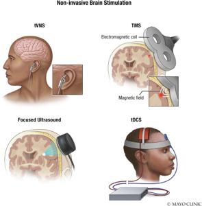 VNS device demonstration