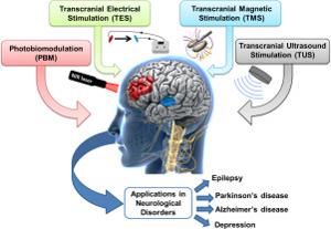 TMS coil stimulating prefrontal cortex