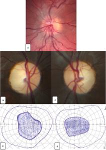 Fundus photographs with visual fields