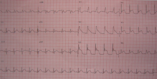 Electrocardiogram resembling STEMI changes in a woman with acute CNS injury due to subarachnoid hemorrhage.
