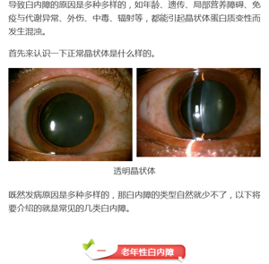 白内障面面观_中国眼科网_www.yanke360.com