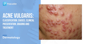 Acne Vulgaris: Classification, Causes, Clinical Presentation