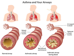 Asthma - Philadelphia FIGHT