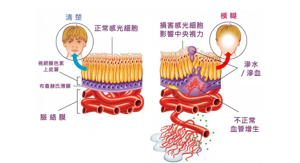 老年黃斑病變– 中大眼科CUHK DOVS