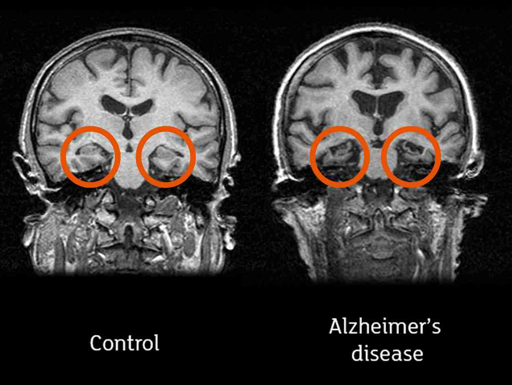 Side-by-side axial brain MRI scans labeled Control (left) and Alzheimer's disease (right), with orange circles highlighting regions of brain atrophy or ventricular enlargement in the Alzheimer's scan compared to the healthy control.