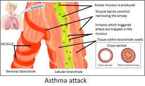Asthma - Wikipedia