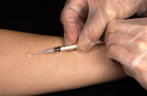 Mantoux test - labtestzote.com
