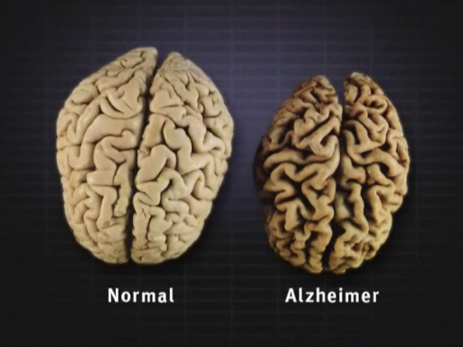 Side-by-side 3D renderings of a normal human brain (left) and an Alzheimer's-affected brain (right), showing greater shrinkage and more pronounced sulci in the diseased brain.